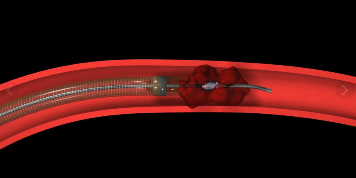Mechanical Thrombectomy Devices Market Analysis, Growth, Industry Trends, Forecast and Sales to 2030